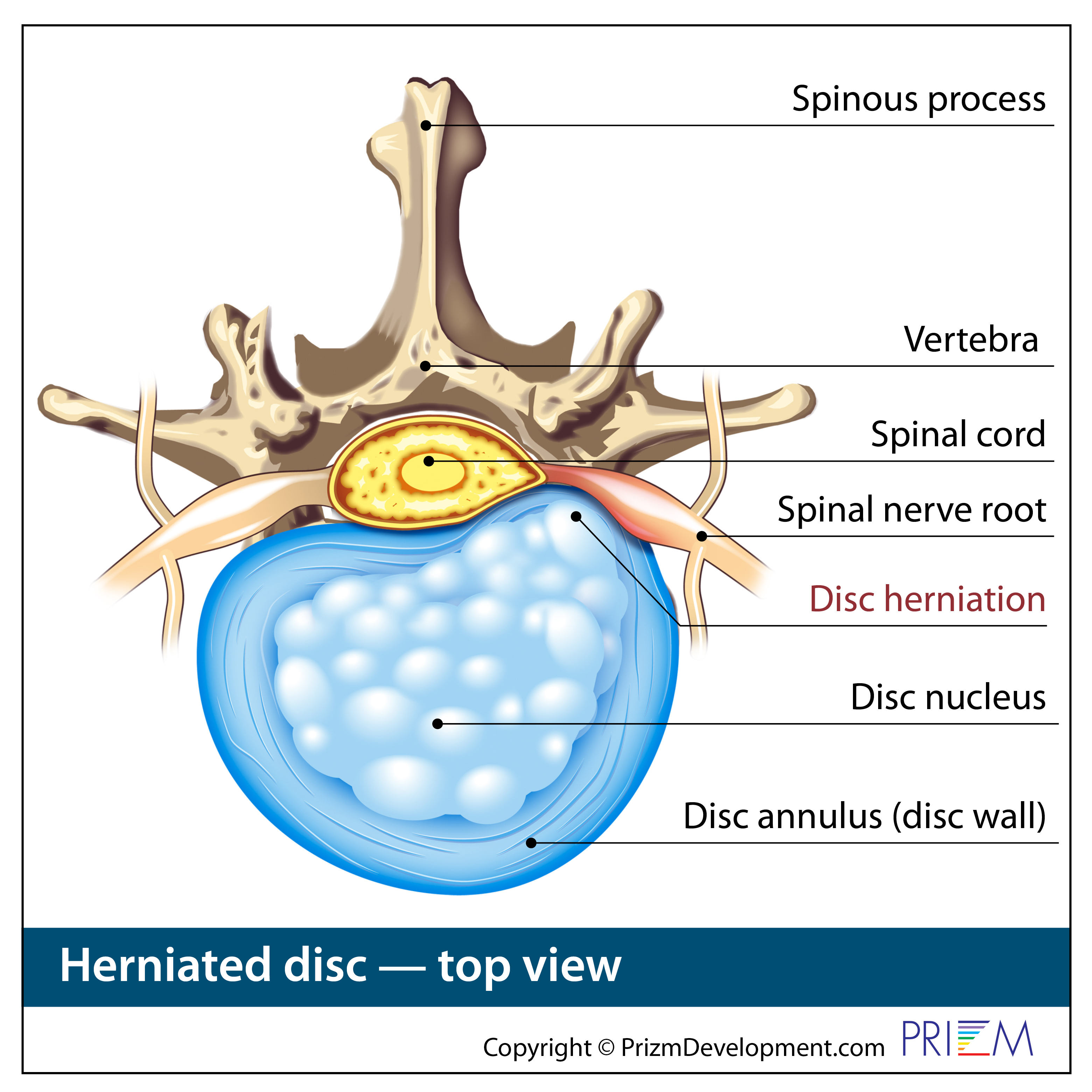 herniated disc treatment
